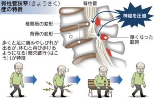 歩行時の症状と前かがみ姿勢