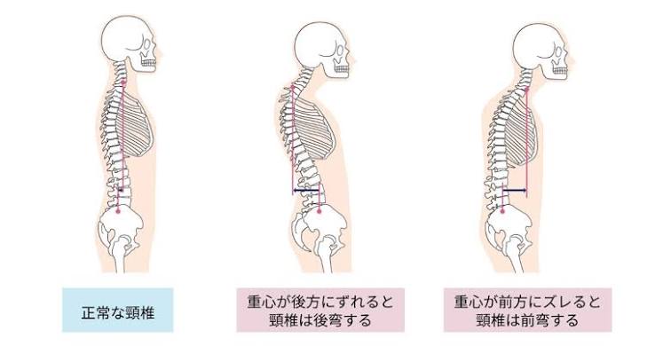 姿勢が崩れた骨格